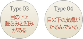 目の下に膨らみと凹みがある目の下の皮膚がたるんでいる