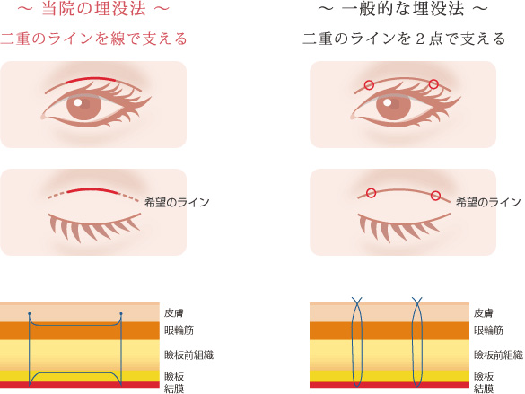 〜当院の埋没法〜二重のラインを線で支える 〜一般的な埋没法〜二重のラインを2点で支える