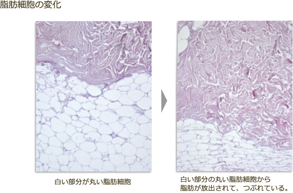 脂肪細胞の変化