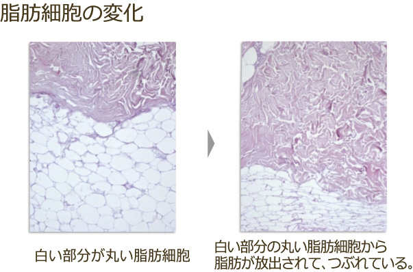 脂肪細胞の変化
