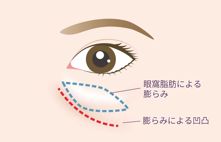 目の下が膨らんでいる