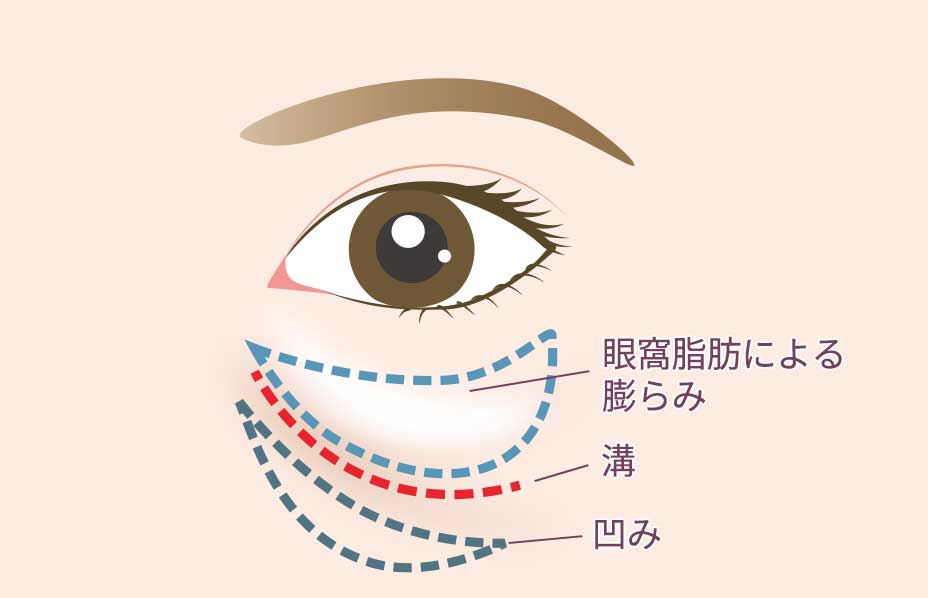 目の下の膨らみと凹みが混合している