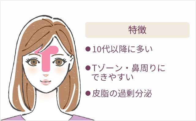 特徴 ●10代以降に多い ●Tゾーン・鼻周りにできやすい ●皮脂の過剰分泌