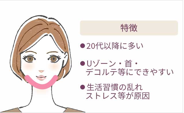 特徴 ●20代以降に多い ●Uゾーン・首・デコルテ等にできやすい ●生活習慣の乱れストレス等が原因