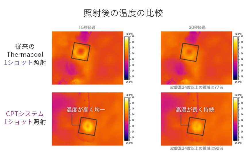 サーマクールCPT|美容外科形成外科川崎中央クリニック【公式】 サーマクールCPT|美容外科形成外科川崎中央クリニック【公式】
